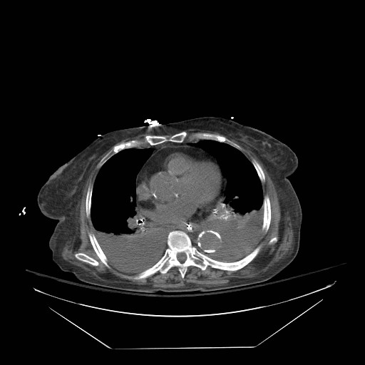 File:Abdominal aortic aneurysm - impending rupture (Radiopaedia 19233-19247 Axial non-contrast 10).jpg
