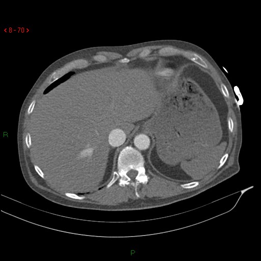 Abdominal aortic aneurysm rupture with aortocaval fistula (Radiopaedia 14897-14841 Axial C+ arterial phase 70).jpg