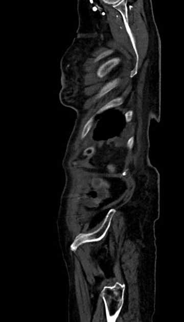 Abdominal aortic aneurysm with thrombus fissuration (Radiopaedia 73192-83919 Sagittal C+ arterial phase 5).jpg