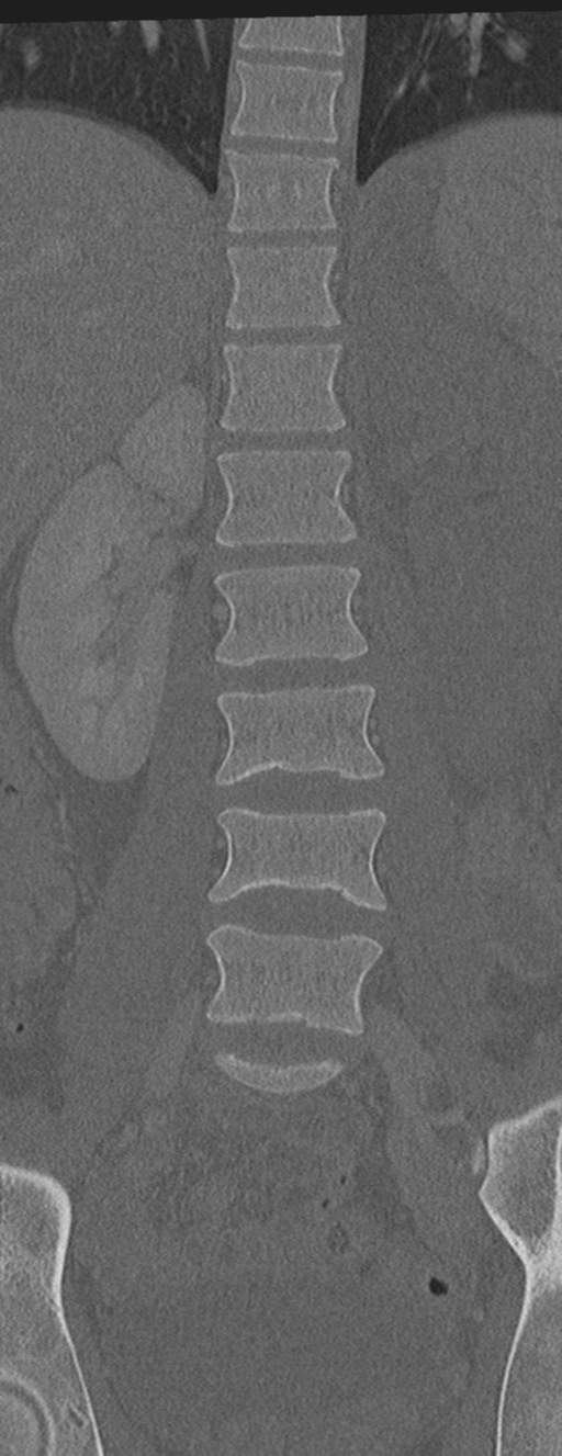 Abdominal multi-trauma - devascularised kidney and liver, spleen and pancreatic lacerations (Radiopaedia 34984-36486 Coronal bone window 26).png
