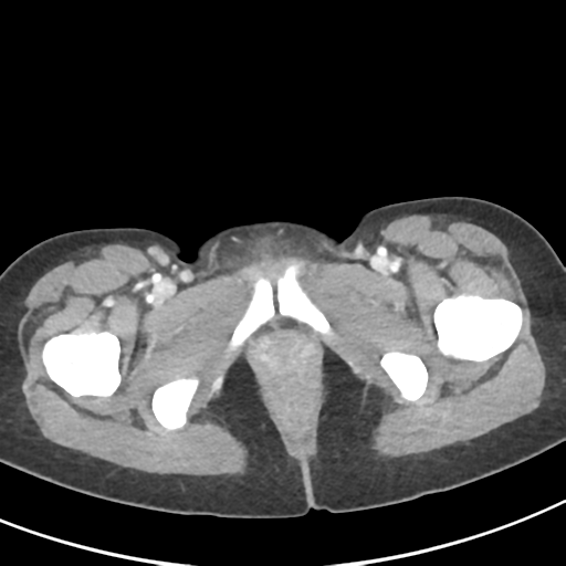 File:Abdominal tuberculosis and appendicitis (Radiopaedia 65631-74735 Axial C+ portal venous phase 73).png