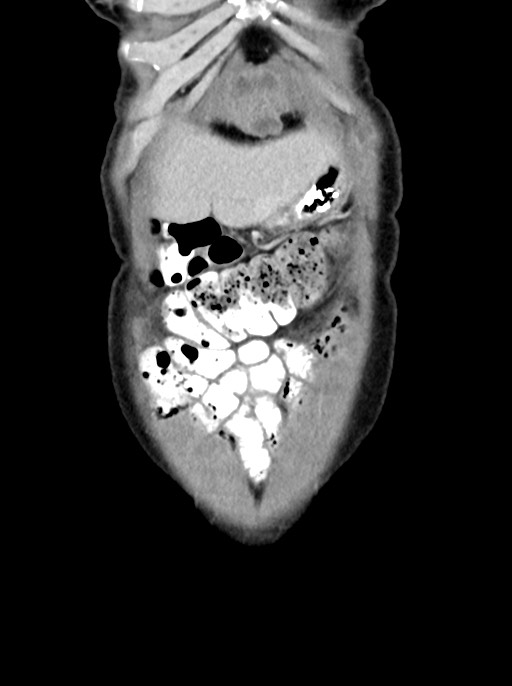 Abdominal wall and retroperitoneal tuberculosis (Radiopaedia 88137-104729 Coronal C+ portal venous phase 15).jpg