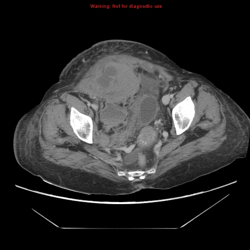File:Abdominal wall hematoma (Radiopaedia 9427-10112 Axial C+ portal venous phase 95).jpg