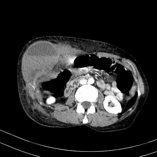 Abdominal wall hematoma with active bleeding (Radiopaedia 83915-99117 Axial renal cortical phase 37).jpg