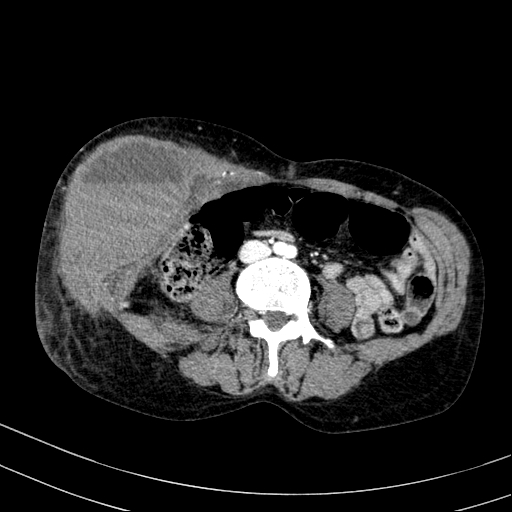 File:Abdominal wall hematoma with active bleeding (Radiopaedia 83915-99117 Axial renal cortical phase 62).jpg