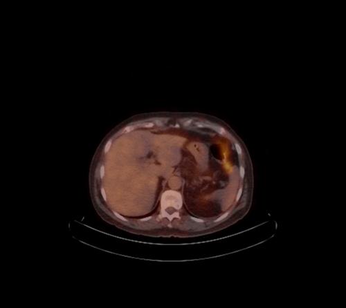 File:Abdominal wall metastasis from colorectal carcinoma (Radiopaedia 31016-31719 C 86).jpg