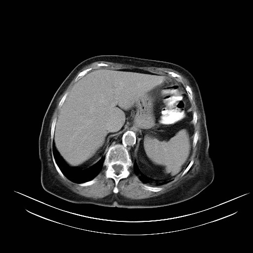 File:Abdominal wall recurrence after colorectal resection for cancer (Radiopaedia 23444-23523 Axial C+ portal venous phase 3).jpg