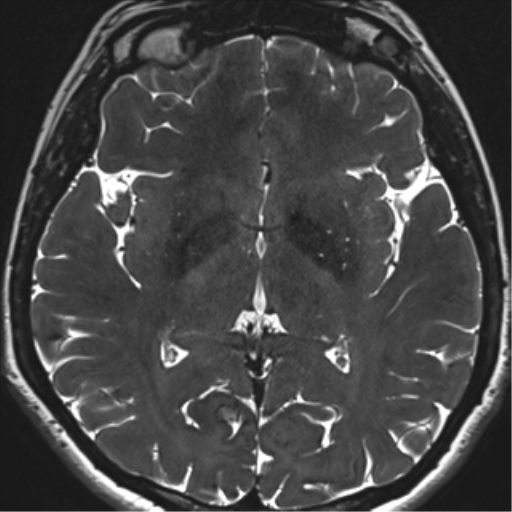 Abducens nerve palsy (Radiopaedia 51069-56648 Axial T2 fat sat 94).png