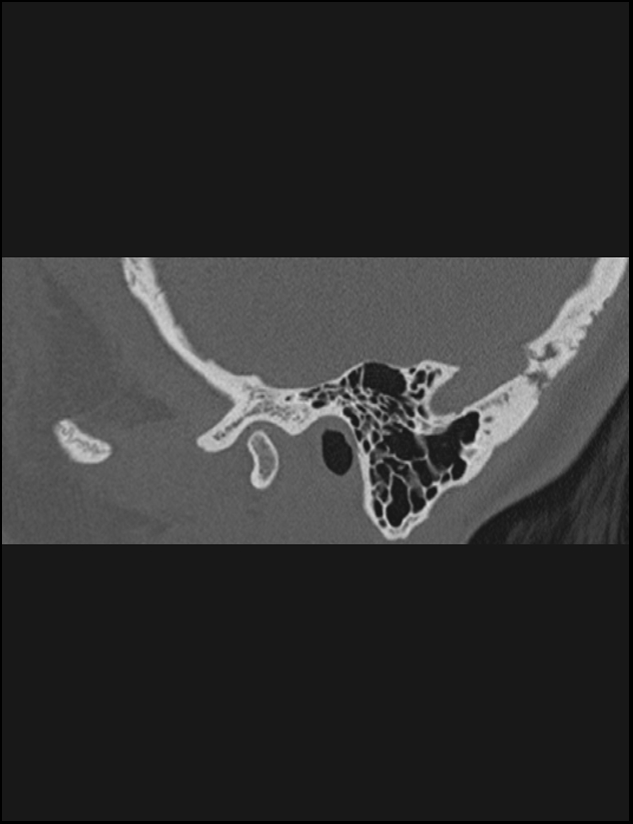 Aberrant right internal carotid artery (Radiopaedia 65191-74198 Sagittal non-contrast 24).jpg