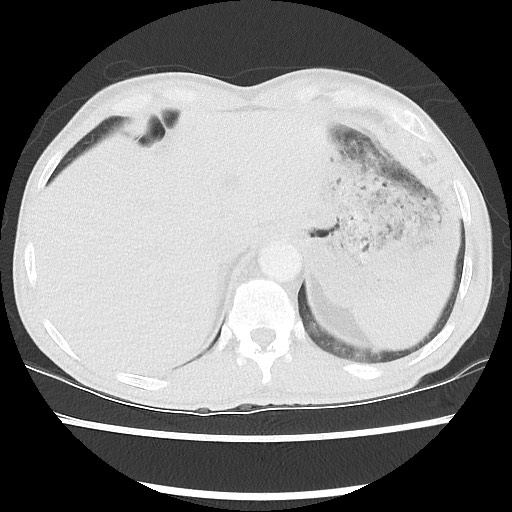 Accessory left horizontal fissure with lingular pneumonia (Radiopaedia 53763-59843 Axial lung window 49).jpg