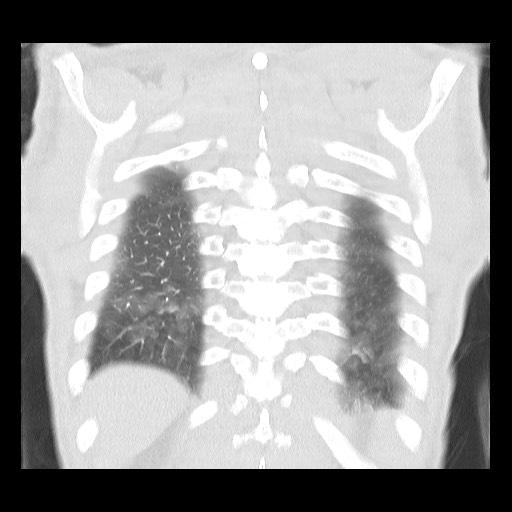 Accessory left horizontal fissure with lingular pneumonia (Radiopaedia 53763-59843 Coronal lung window 39).jpg
