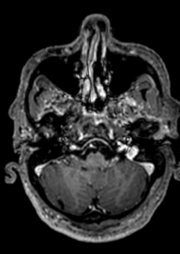 Accessory middle cerebral artery (Radiopaedia 73114-83828 Axial T1 C+ 147).jpg