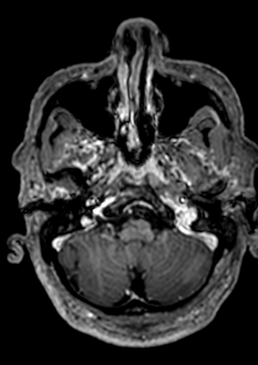 Accessory middle cerebral artery (Radiopaedia 73114-83828 Axial T1 C+ 153).jpg