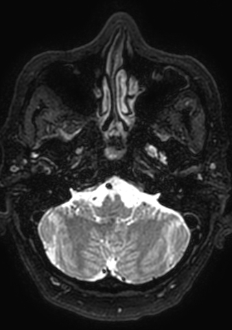 Accessory middle cerebral artery (Radiopaedia 73114-83828 Axial T2 183).jpg