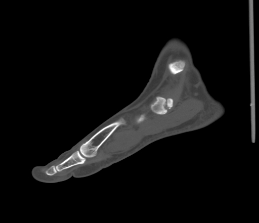 File:Accessory navicular bone (Radiopaedia 54999-61314 Sagittal non-contrast 26).jpg
