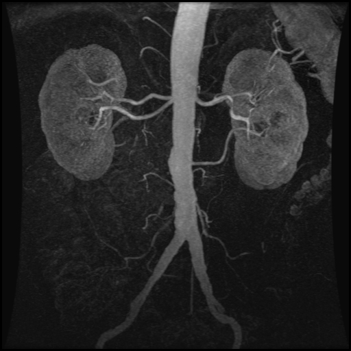 File:Accessory renal arteries (Radiopaedia 17245).jpg