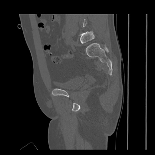 Acetabular and ilial fractures (Radiopaedia 59084-66378 Sagittal bone window 42).jpg