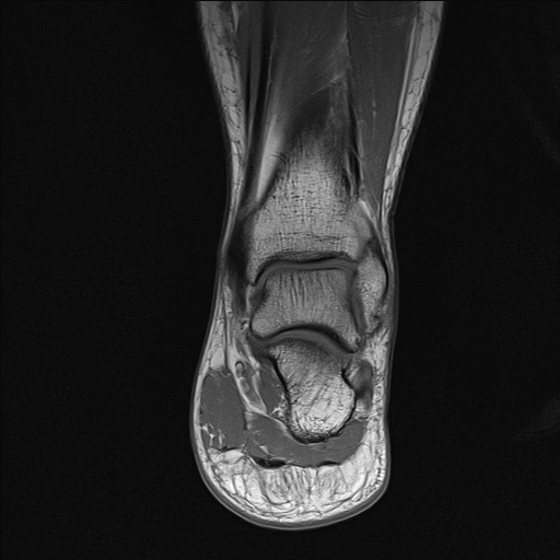 File:Achilles tendon tear (Radiopaedia 77615-89819 Coronal T1 18).jpg
