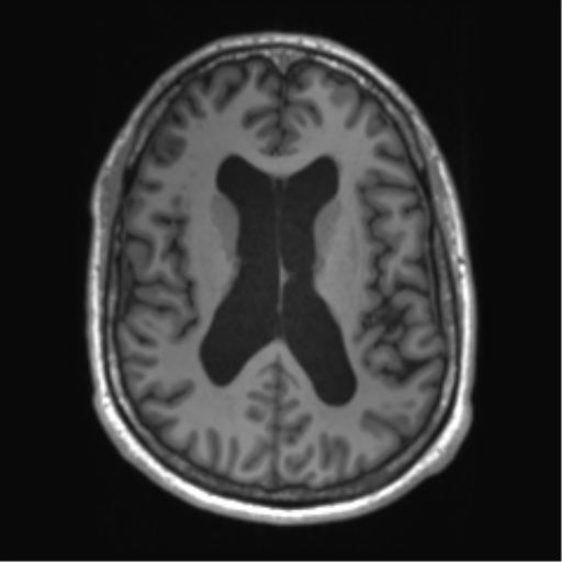 File:Achondroplasia (Radiopaedia 65109-74105 Axial T1 23).png