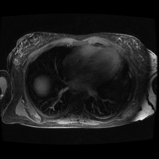 Acinar cell carcinoma of the pancreas (Radiopaedia 75442-86668 Axial late phase (~30 mins) 146).jpg
