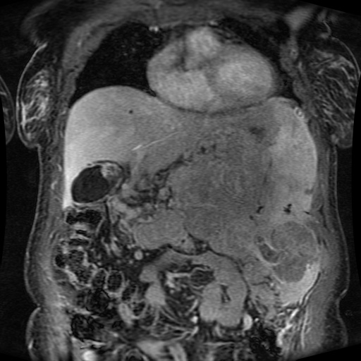 Acinar cell carcinoma of the pancreas (Radiopaedia 75442-86668 Coronal T1 C+ fat sat 130).jpg
