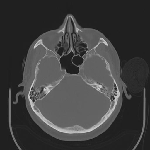 File:Acoustic schwannoma (Radiopaedia 29488-29982 AXIAL BONE THICK non-contrast 14).jpg