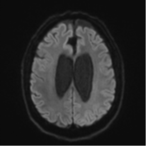 Acoustic schwannoma (Radiopaedia 55729-62281 E 46).png