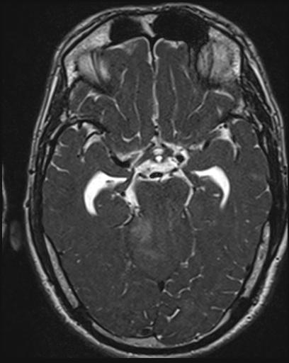 File:Acoustic schwannoma - probable (Radiopaedia 20386-20292 Axial T1 59).jpg