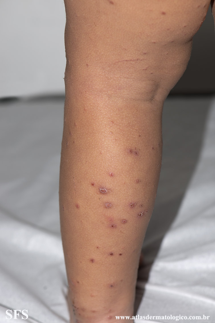 Acrodermatitis Infantile Papular (Dermatology Atlas 22).jpg