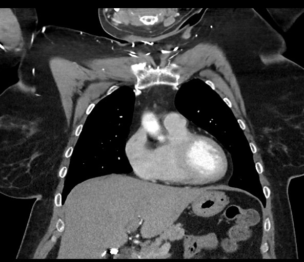 Acromioclavicular joint cyst (Radiopaedia 58455-65610 Coronal C+ arterial phase 54).jpg