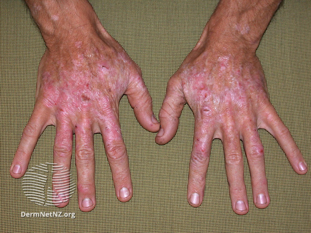 File:Actinic keratoses affecting the hands (DermNet NZ lesions-ak-hands-406).jpg