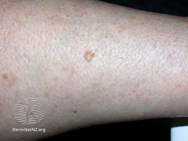 File:Actinic keratoses affecting the legs and feet (DermNet NZ lesions-ak-legs-311).jpg