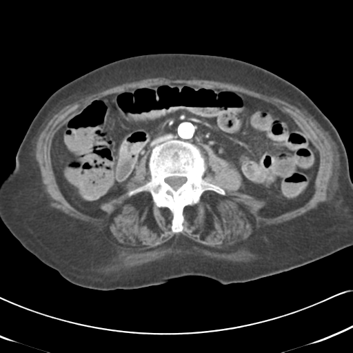 File:Active bleeding from duodenal ulcer with embolization (Radiopaedia 34216-35481 C 32).png