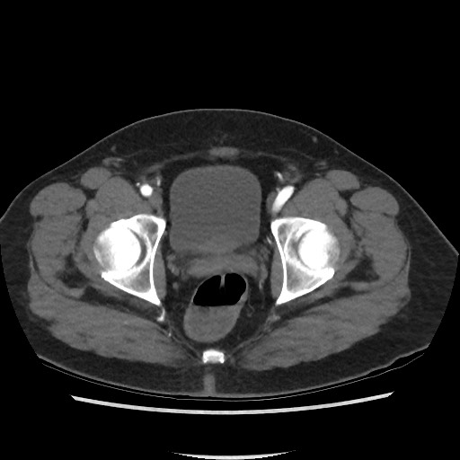 File:Active colonic bleed on CT (Radiopaedia 49765-55025 Axial C+ arterial phase 77).jpg