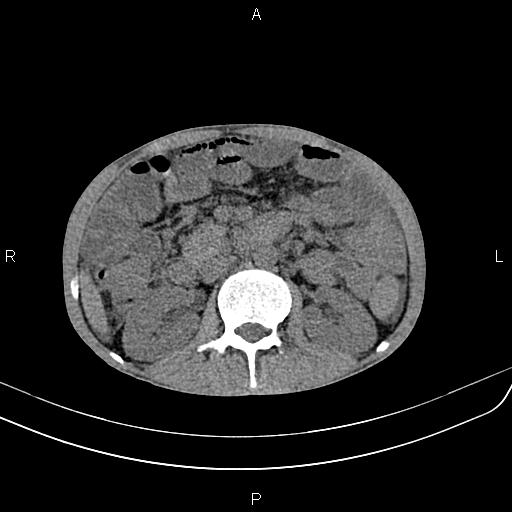 File:Active crohn disease (Radiopaedia 87133-103397 Axial non-contrast 42).jpg