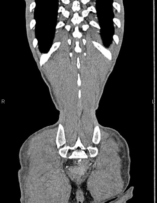 Active crohn disease (Radiopaedia 87133-103397 Coronal C+ arterial phase 61).jpg