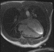 Active right ventricular cardiac sarcoidosis (Radiopaedia 55596-62100 Axial Dynamic perfusion scan MOCO 80).jpg