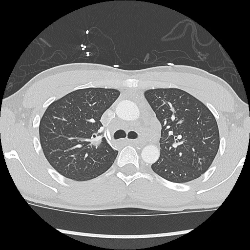 File:Active right ventricular cardiac sarcoidosis (Radiopaedia 55596-62101 Axial lung window 12).jpg