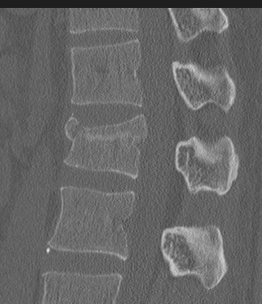 Acute L1 burst compression fracture (Radiopaedia 34430-35755 Sagittal bone window 34).png