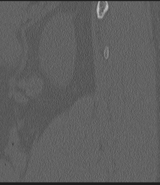 Acute L1 burst compression fracture (Radiopaedia 34430-35755 Sagittal bone window 7).png