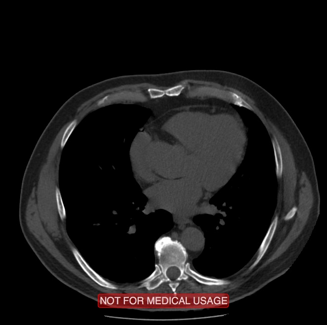 Acute aortic dissection - Stanford type A (Radiopaedia 40661-43285 Axial non-contrast 37).jpg