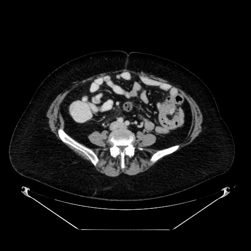 File:Acute appendicitis, heterotaxy syndrome (Radiopaedia 66884-76202 Axial C+ portal venous phase 81).jpg