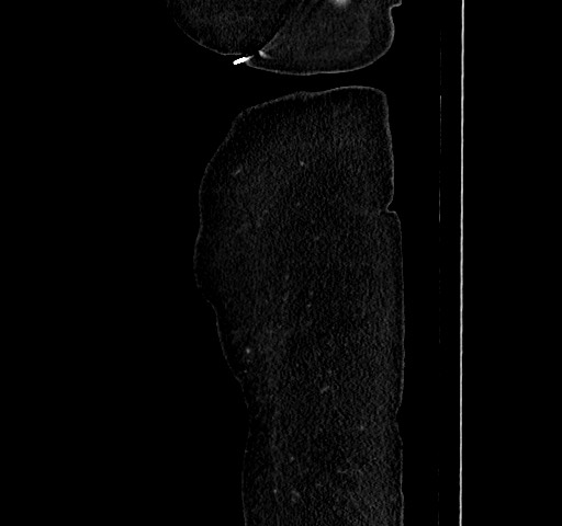 File:Acute appendicitis, heterotaxy syndrome (Radiopaedia 66884-76202 Sagittal C+ portal venous phase 127).jpg