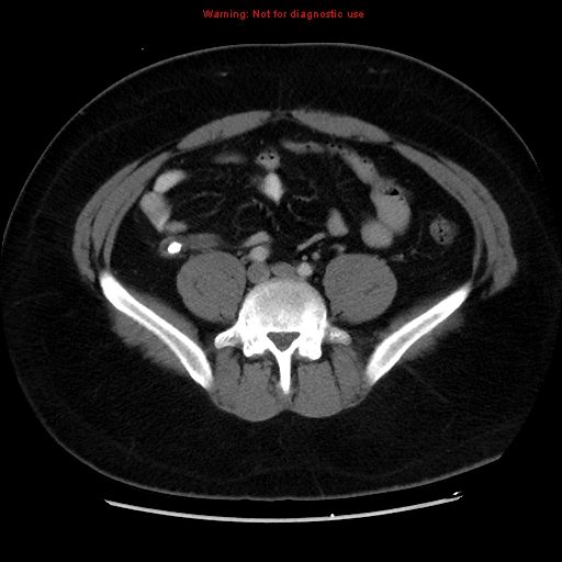 File:Acute appendicitis (Radiopaedia 12326-12607 Axial C+ portal venous phase 23).jpg