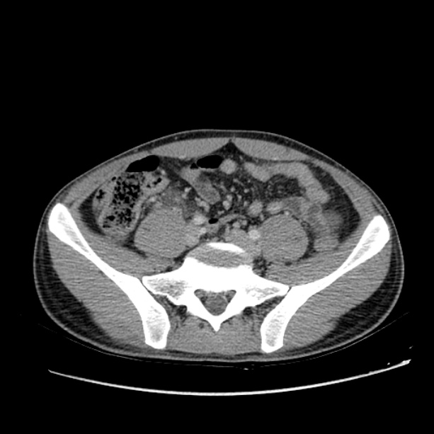 Acute appendicitis (Radiopaedia 27049-27227 Axial C+ portal venous phase 52).jpg