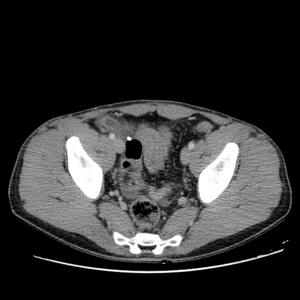 Acute appendicitis (Radiopaedia 27049-27227 Axial C+ portal venous phase 64).jpg
