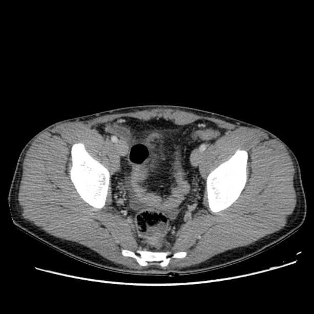 Acute appendicitis (Radiopaedia 27049-27227 Axial C+ portal venous phase 66).jpg