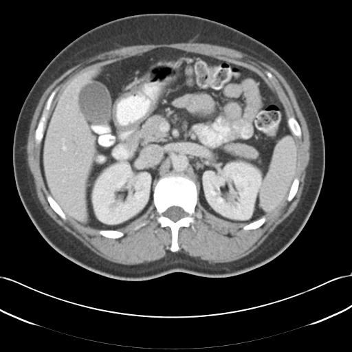 Acute appendicitis (Radiopaedia 30297-30934 Axial C+ portal venous phase 27).jpg