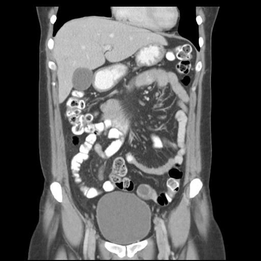 Acute appendicitis (Radiopaedia 30297-30934 Coronal C+ portal venous phase 16).jpg