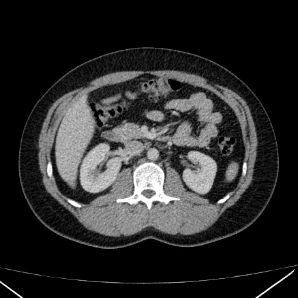 Acute appendicitis (Radiopaedia 38255-40270 Axial C+ portal venous phase 42).jpg